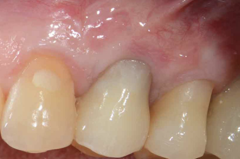 problemi denti chirurgia mucogengivale