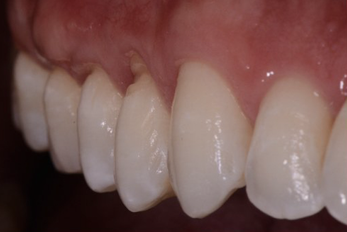 denti chirurgia mucogengivale