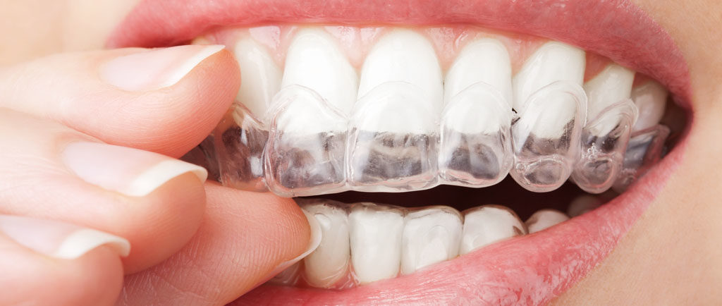 ortodonzia estetica | Odontoiatria FQ | dentista arezzo