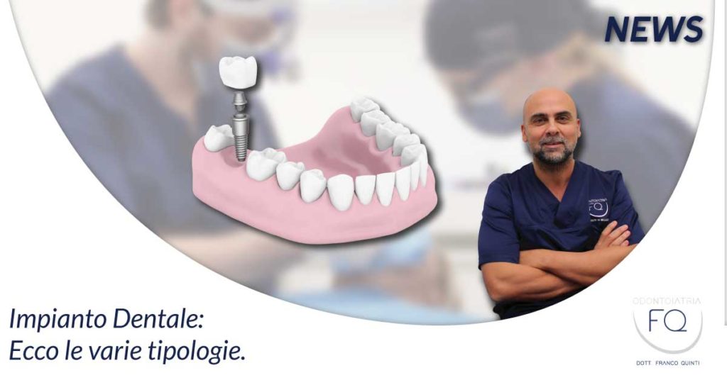 tipi di impianti dentali - Odontoiatria FQ - Dentista Arezzo