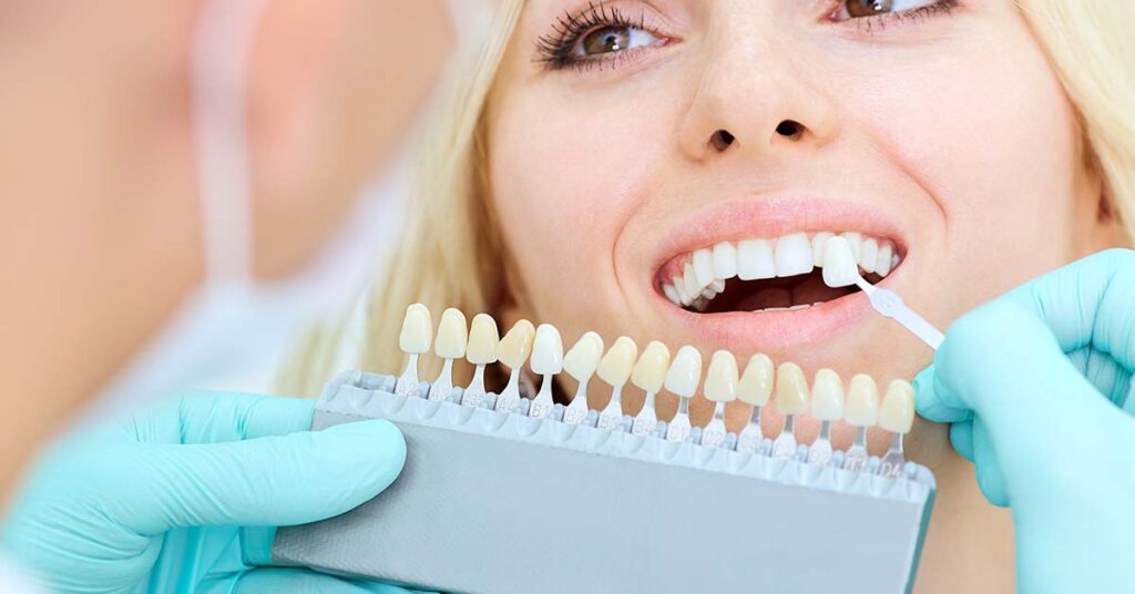 Faccette estetiche dentali | Odontoiatria FQ